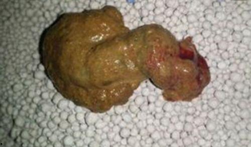 吃二甲双瓜拉黑屎怎么办,紧急处理与预防措施